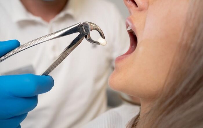 The Importance of Wisdom Teeth Removal