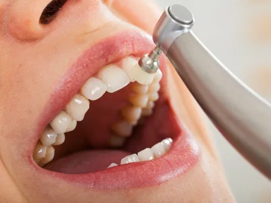 What You Need to Know About Professional Teeth Cleaning vs. At-Home Care
